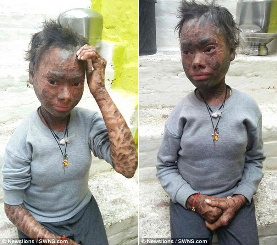 Фотография: Девочка-змея сбрасывает кожу каждые полтора месяца №6 - BigPicture.ru