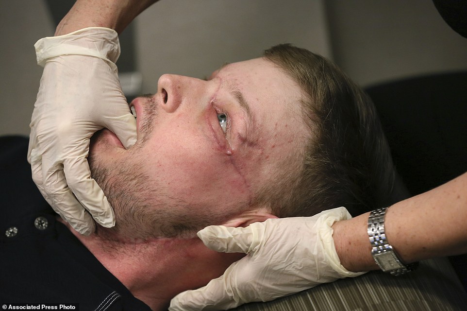 Фотография: Неудавшемуся самоубийце пересадили лицо, и у него началась новая жизнь №18 - BigPicture.ru