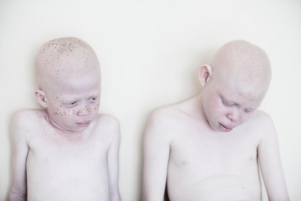 Фотография: Смертельная белизна: невероятные портреты альбиносов Танзании №6 - BigPicture.ru