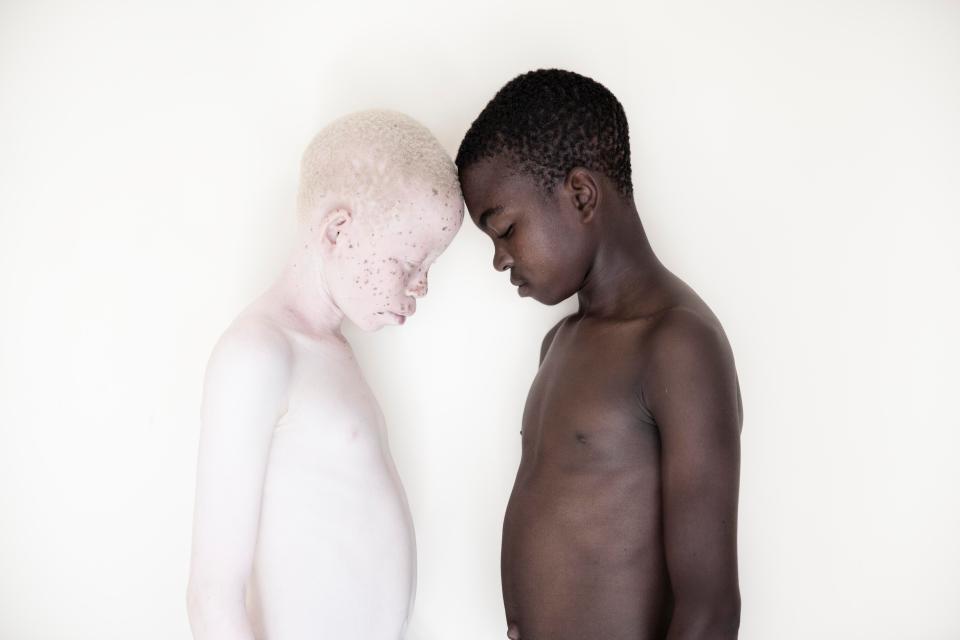 Фотография: Смертельная белизна: невероятные портреты альбиносов Танзании №10 - BigPicture.ru
