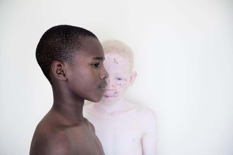 Фотография: Смертельная белизна: невероятные портреты альбиносов Танзании №12 - BigPicture.ru