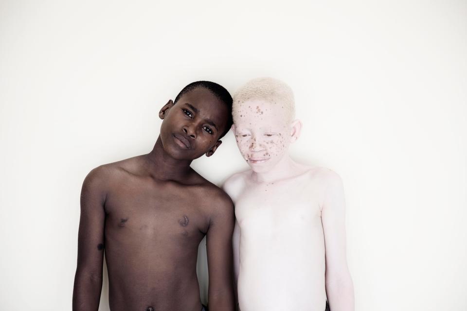 Фотография: Смертельная белизна: невероятные портреты альбиносов Танзании №2 - BigPicture.ru