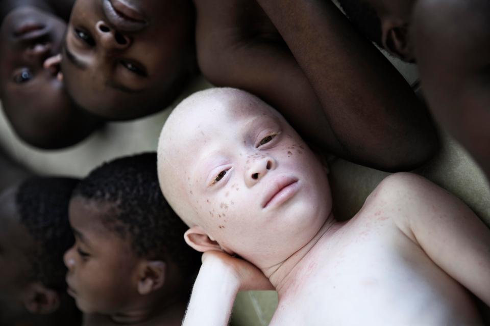 Фотография: Смертельная белизна: невероятные портреты альбиносов Танзании №14 - BigPicture.ru