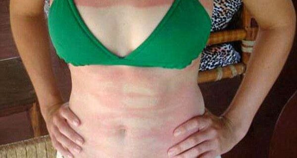 Сверху черный, снизу белый — самые провальные попытки загореть