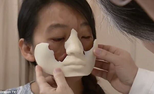 Китаянке с деформированным лицом врачи выращивают новое лицо на груди