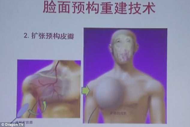 Фотография: Китаянке с деформированным лицом врачи выращивают новое лицо на груди №5 - BigPicture.ru