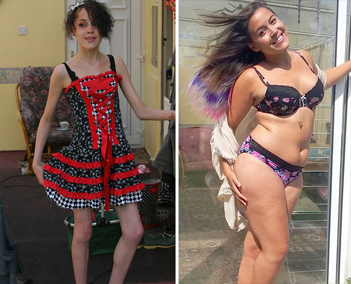 Фотография: До и после: 20 примеров людей, сумевших побороть анорексию №11 - BigPicture.ru