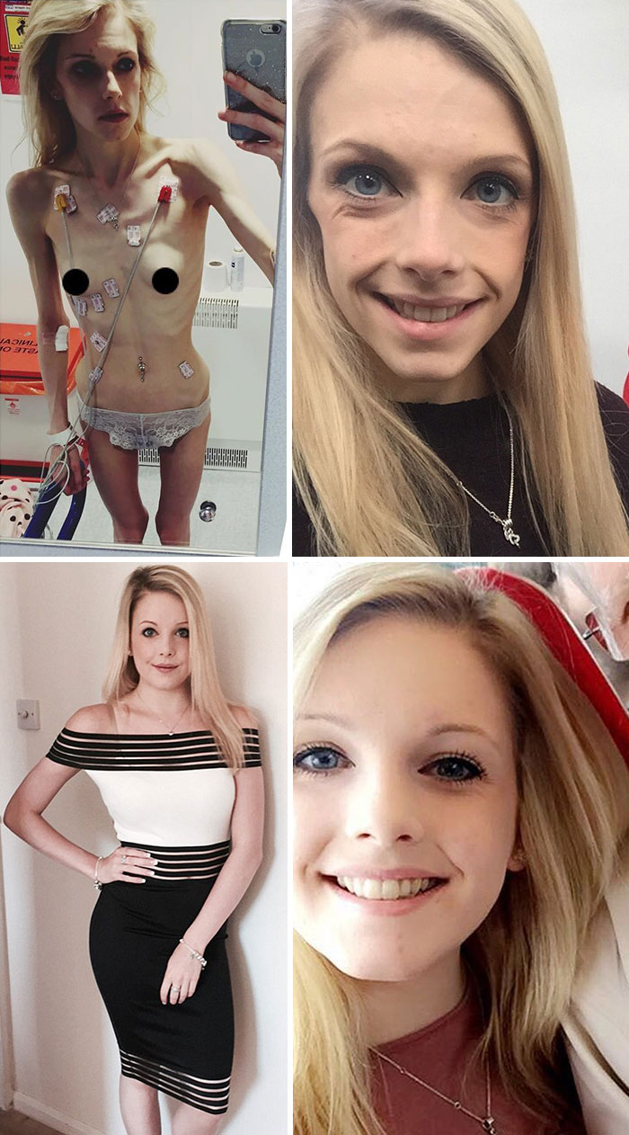 Фотография: До и после: 20 примеров людей, сумевших побороть анорексию №12 - BigPicture.ru