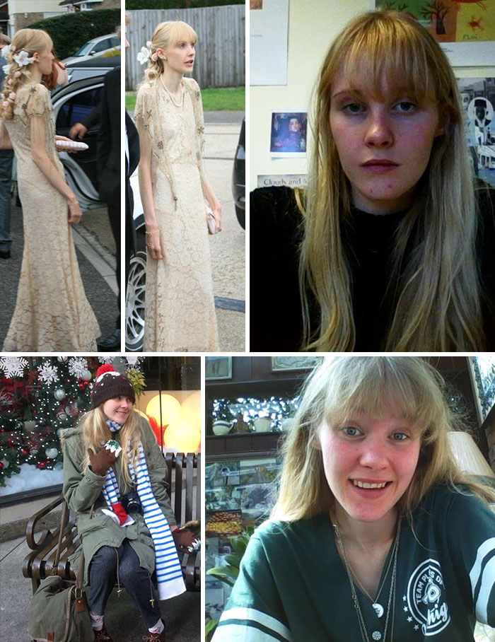 Фотография: До и после: 20 примеров людей, сумевших побороть анорексию №14 - BigPicture.ru
