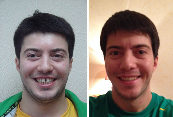 Фотография: Вот как кардинально брекеты меняют улыбку и жизнь №17 - BigPicture.ru
