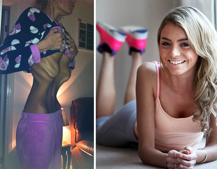 Фотография: До и после: 20 примеров людей, сумевших побороть анорексию №18 - BigPicture.ru
