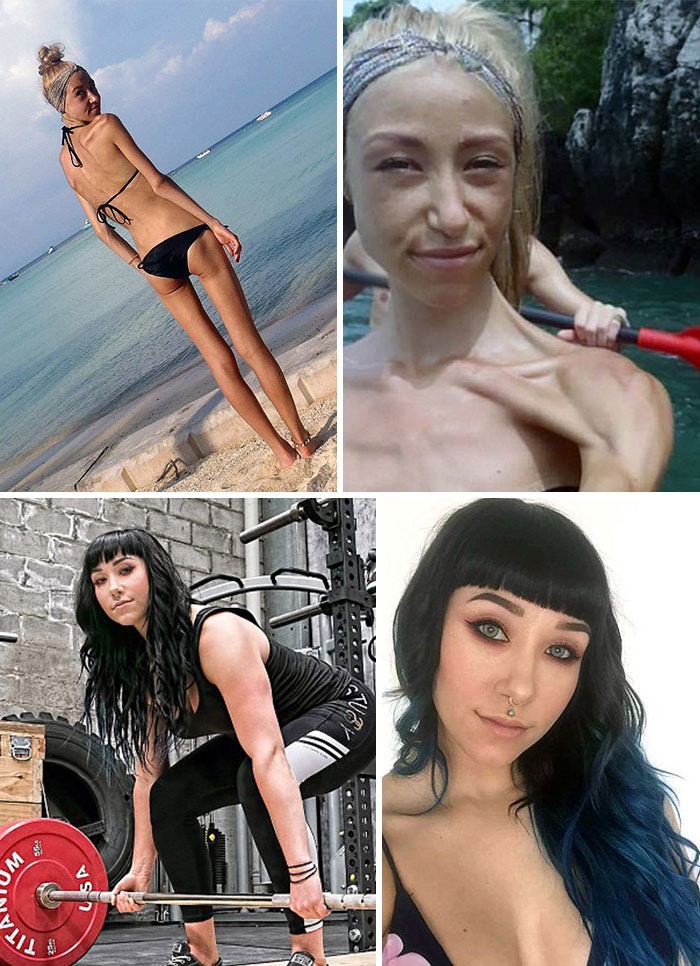 Фотография: До и после: 20 примеров людей, сумевших побороть анорексию №21 - BigPicture.ru
