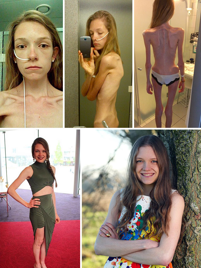 Фотография: До и после: 20 примеров людей, сумевших побороть анорексию №3 - BigPicture.ru