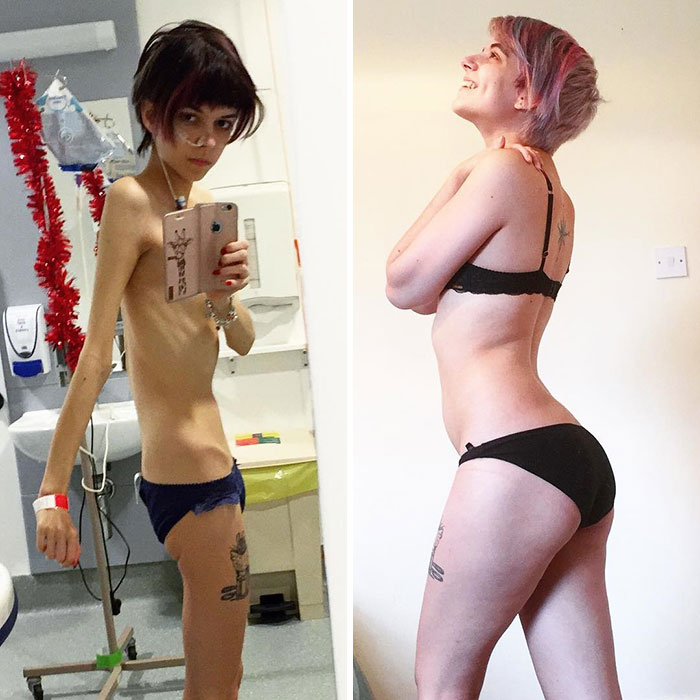 Фотография: До и после: 20 примеров людей, сумевших побороть анорексию №4 - BigPicture.ru