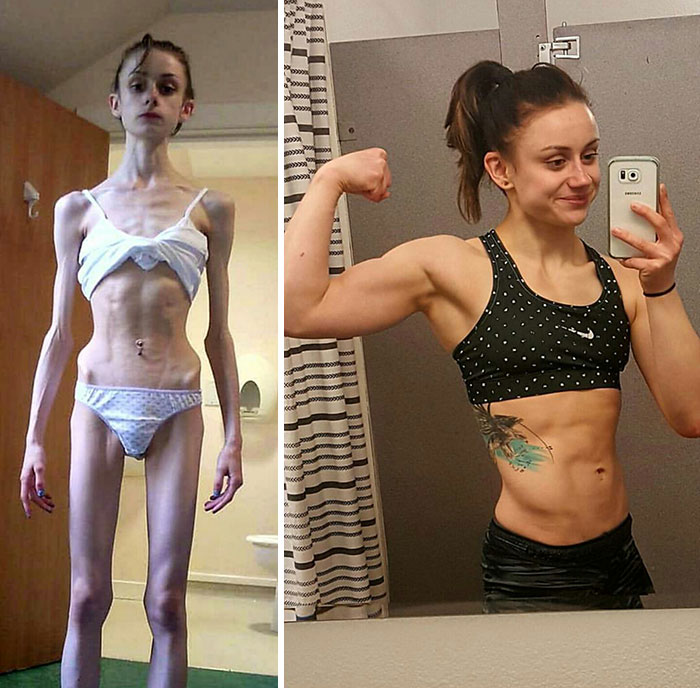 Фотография: До и после: 20 примеров людей, сумевших побороть анорексию №5 - BigPicture.ru