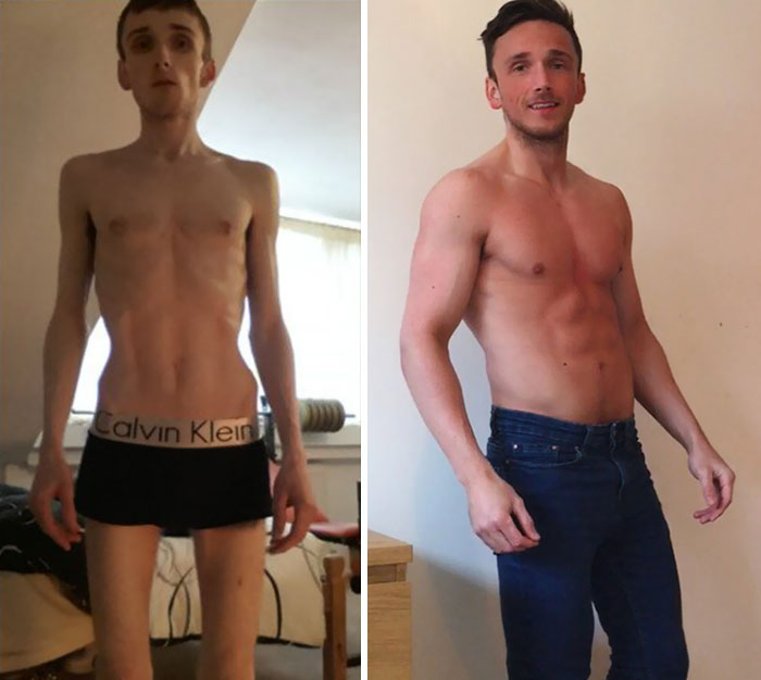 Фотография: До и после: 20 примеров людей, сумевших побороть анорексию №6 - BigPicture.ru