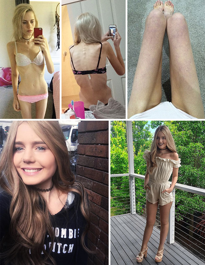 Фотография: До и после: 20 примеров людей, сумевших побороть анорексию №8 - BigPicture.ru