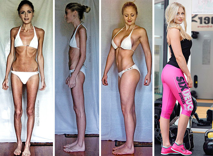 Фотография: До и после: 20 примеров людей, сумевших побороть анорексию №9 - BigPicture.ru