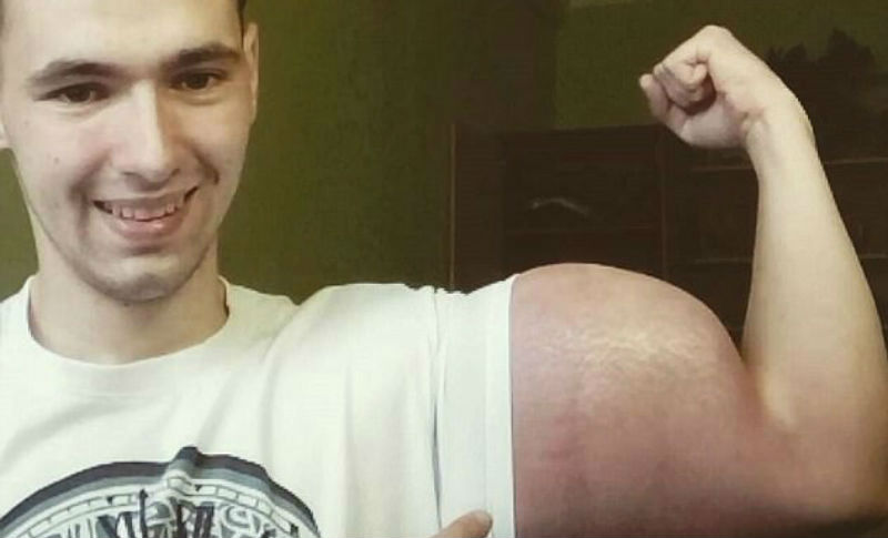 Фотография: Тело, за которое можно умереть: россиянин делает инъекции опасным препаратом, чтобы увеличить объем бицепсов №1 - BigPicture.ru