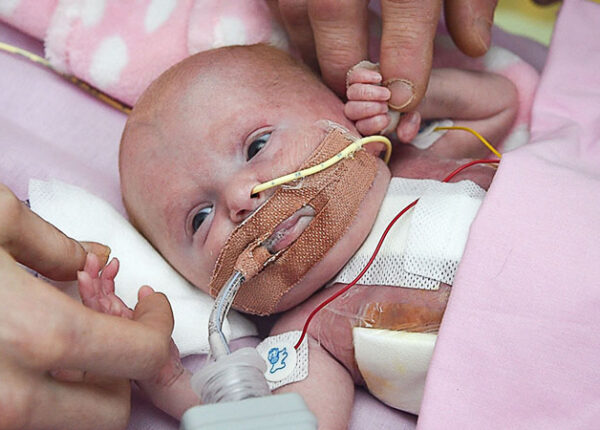 Британские врачи спасли малышку, которая родилась с сердцем наружу