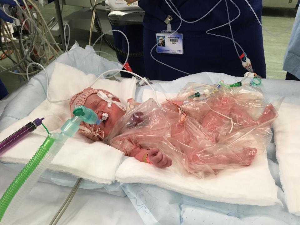 Фотография: Британские врачи спасли малышку, которая родилась с сердцем наружу №6 - BigPicture.ru