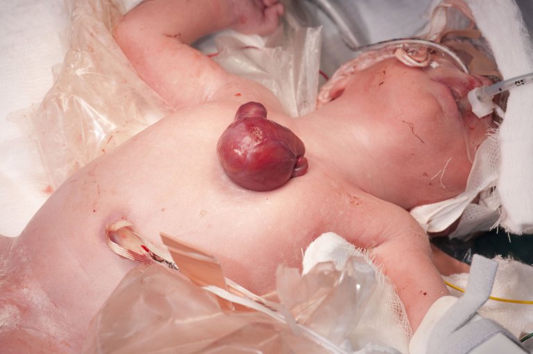 Фотография: Британские врачи спасли малышку, которая родилась с сердцем наружу №3 - BigPicture.ru
