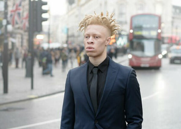 «Я дрался каждый день»: как парень-альбинос из объекта насмешек превратился в востребованную модель