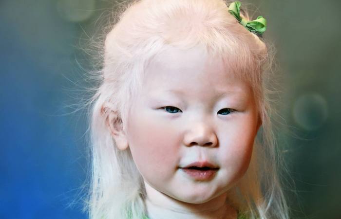 как выглядят альбиносы разных национальностей
