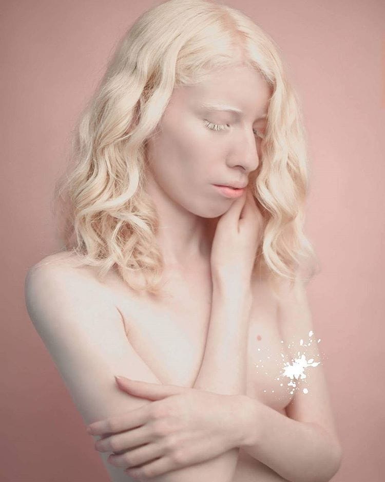 Фотография: Как выглядят альбиносы разных национальностей и рас №22 - BigPicture.ru