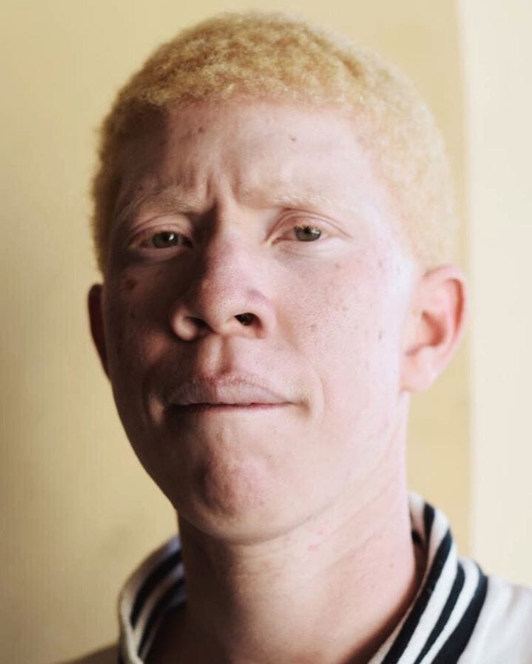Фотография: Как выглядят альбиносы разных национальностей и рас №9 - BigPicture.ru