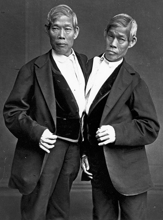 Самые известные сиамские близнецы. Фото