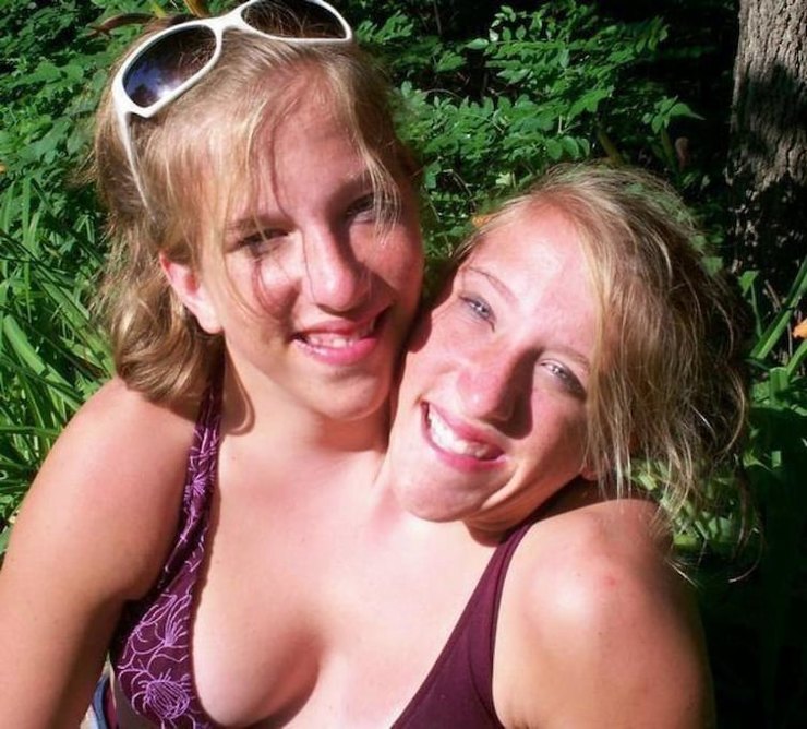 Одна жизнь на двоих без надрыва и трагедий: счастливые сиамские близнецы