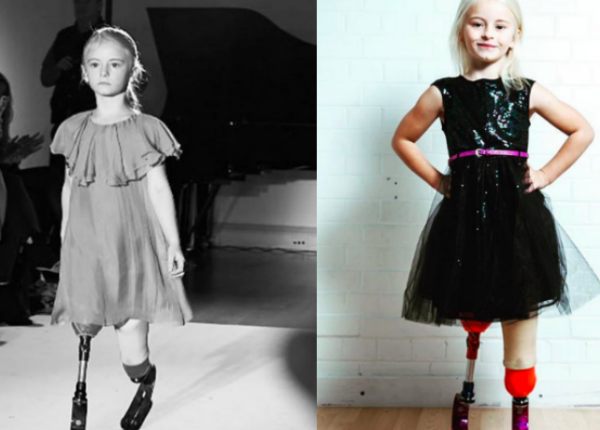 Семилетняя девочка с ампутированными ногами строит карьеру в модельном бизнесе
