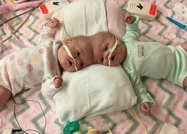 Право на жизнь: 1,5‑годовалые сиамские близнецы, родившиеся со сращенными головами, восстановились после сложнейшей операции и радуются каждому дню