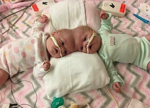 Фотография: Право на жизнь: 1,5-годовалые сиамские близнецы, родившиеся со сращенными головами, восстановились после сложнейшей операции и радуются каждому дню №4 - BigPicture.ru