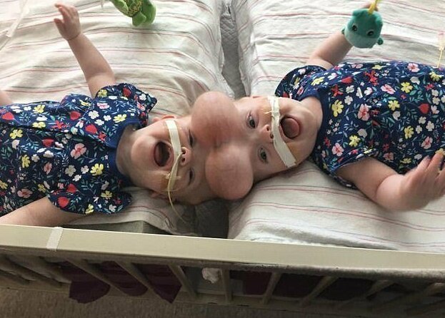 Фотография: Право на жизнь: 1,5-годовалые сиамские близнецы, родившиеся со сращенными головами, восстановились после сложнейшей операции и радуются каждому дню №7 - BigPicture.ru