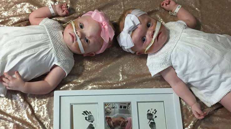 Фотография: Право на жизнь: 1,5-годовалые сиамские близнецы, родившиеся со сращенными головами, восстановились после сложнейшей операции и радуются каждому дню №8 - BigPicture.ru