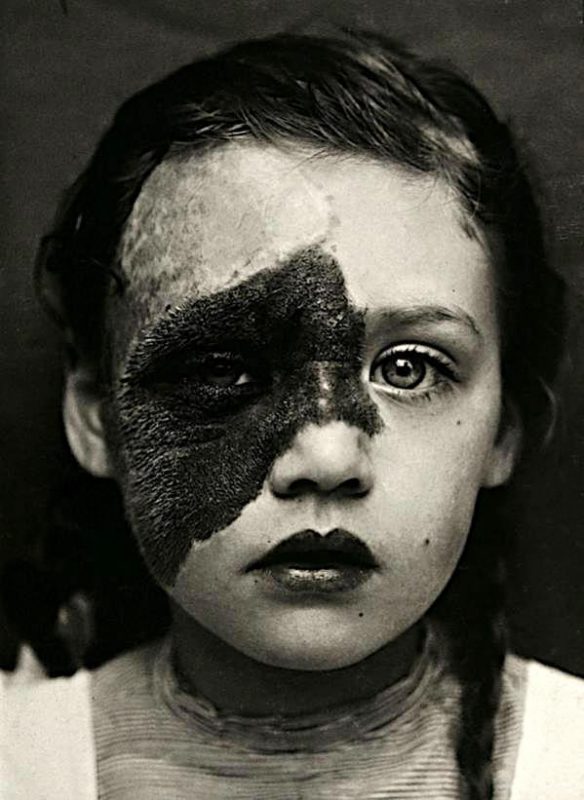 Фотография: Портреты боли: поразительные фотографии пациентов из XIX века, страдающих от тяжких болезней №3 - BigPicture.ru