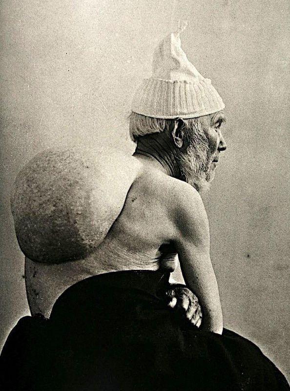 Фотография: Портреты боли: поразительные фотографии пациентов из XIX века, страдающих от тяжких болезней №4 - BigPicture.ru
