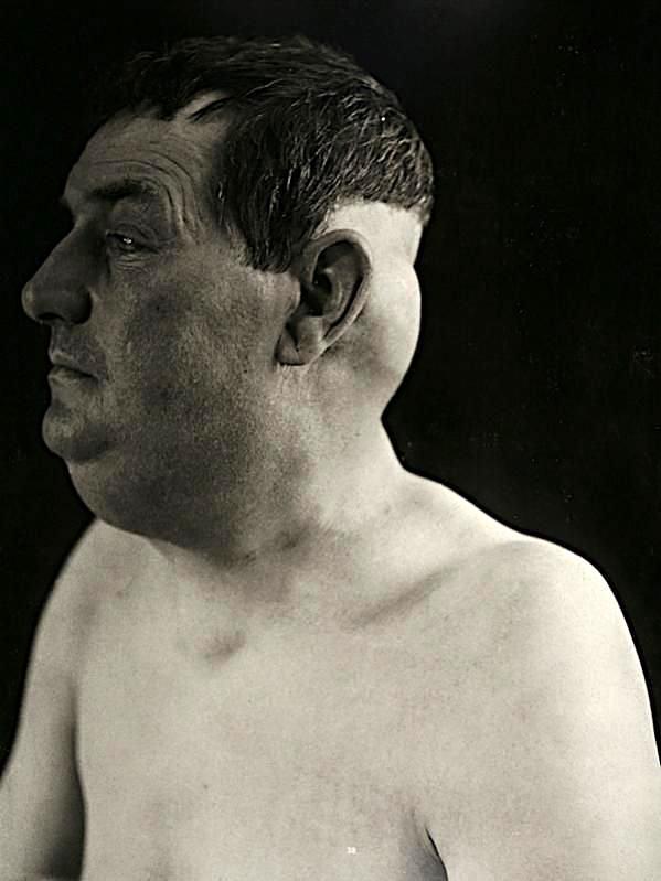 Фотография: Портреты боли: поразительные фотографии пациентов из XIX века, страдающих от тяжких болезней №7 - BigPicture.ru