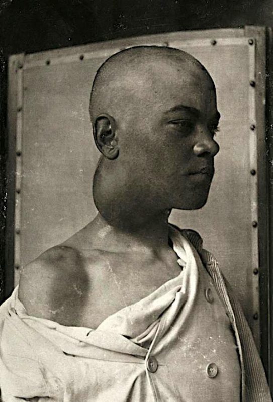 Фотография: Портреты боли: поразительные фотографии пациентов из XIX века, страдающих от тяжких болезней №8 - BigPicture.ru