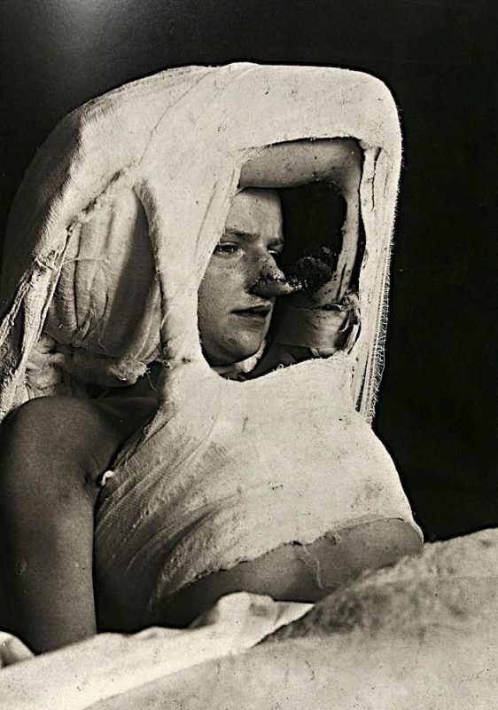 Фотография: Портреты боли: поразительные фотографии пациентов из XIX века, страдающих от тяжких болезней №9 - BigPicture.ru