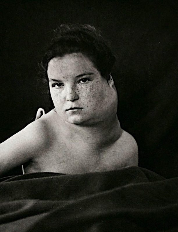 Фотография: Портреты боли: поразительные фотографии пациентов из XIX века, страдающих от тяжких болезней №13 - BigPicture.ru