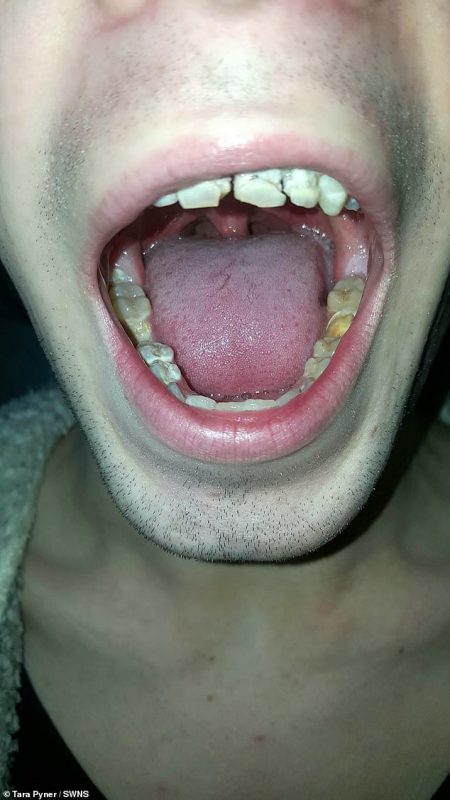 Фотография: Энергетик, разрушивший зубы и жизнь: 21-летний парень потерял улыбку и мечты, регулярно употребляя бодрящий напиток №8 - BigPicture.ru