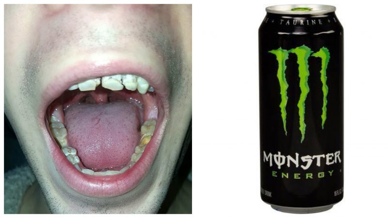Фотография: Энергетик, разрушивший зубы и жизнь: 21-летний парень потерял улыбку и мечты, регулярно употребляя бодрящий напиток №1 - BigPicture.ru