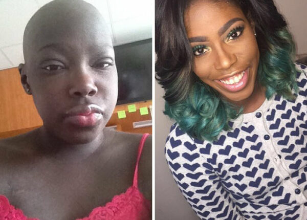 Люди, которые победили рак, в фотографиях «до и после»