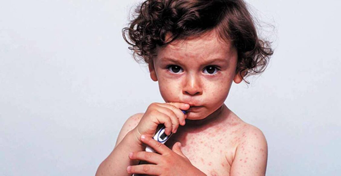 Ребенок, больной корью: крупным планом видна обильная красная сыпь, покрывающая кожу туловища