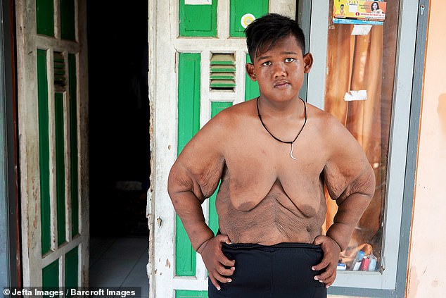 Фотография: Самый толстый мальчик в мире, который весил 192 кг в 10-летнем возрасте, похудел больше, чем вдвое №12 - BigPicture.ru