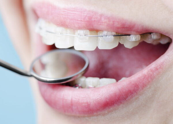 Почему керамические брекеты желтеют или темнеют?