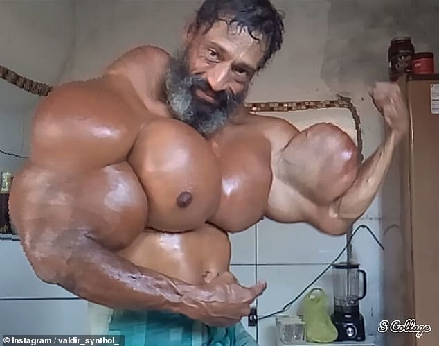 Фотография: Бульбозавр из Бразилии: бывший наркоман делает себе инъекции масла №2 - BigPicture.ru